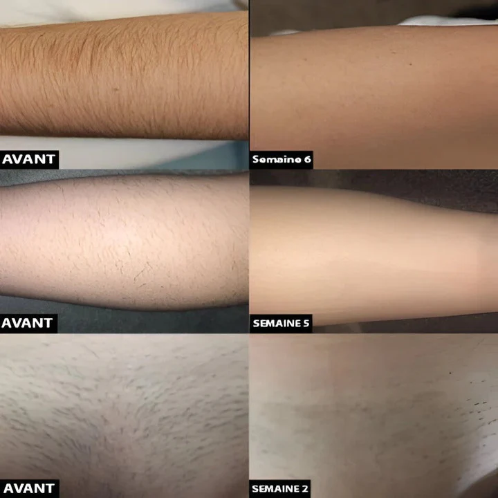 Rechargeable Light Pulse Hair Removal Device - Image 6