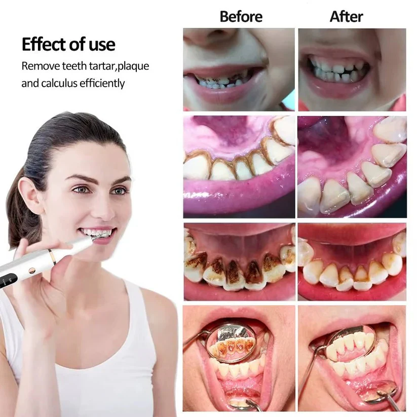 USB Rechargeable Dental Cleaning Kit with LED Light - Image 4