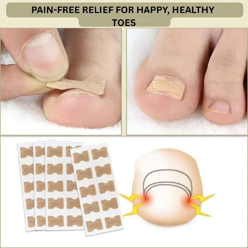 Ingrown Nail Correction Tool with Instant Repair Treatment - Image 3