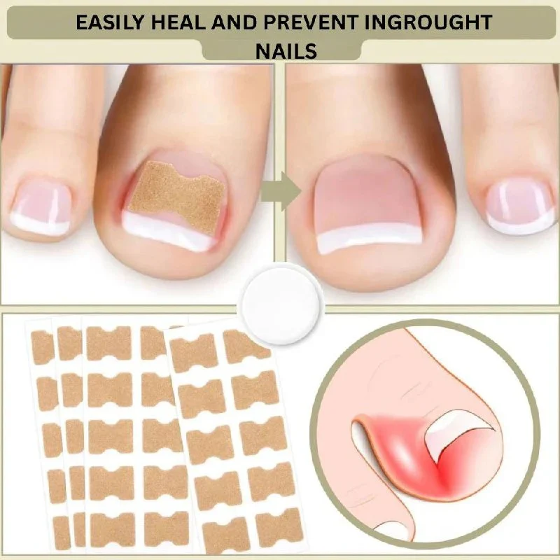 Ingrown Nail Correction Tool with Instant Repair Treatment - Image 4