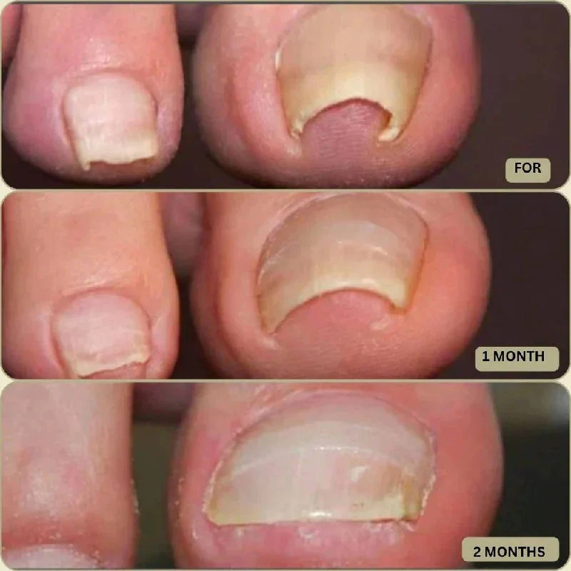 Ingrown Nail Correction Tool with Instant Repair Treatment - Image 5