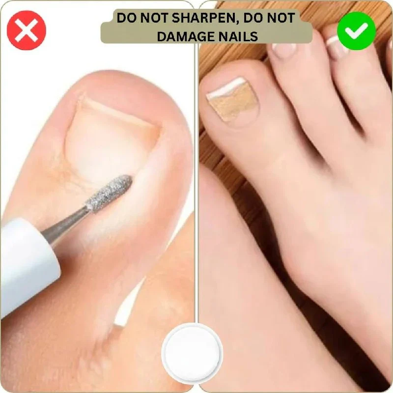 Ingrown Nail Correction Tool with Instant Repair Treatment - Image 6