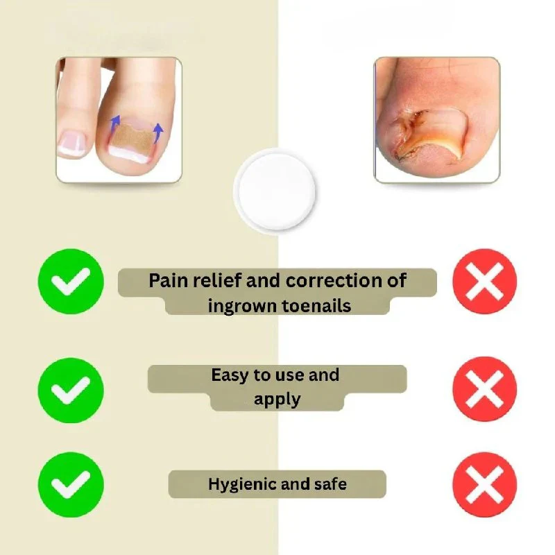 Ingrown Nail Correction Tool with Instant Repair Treatment - Image 7