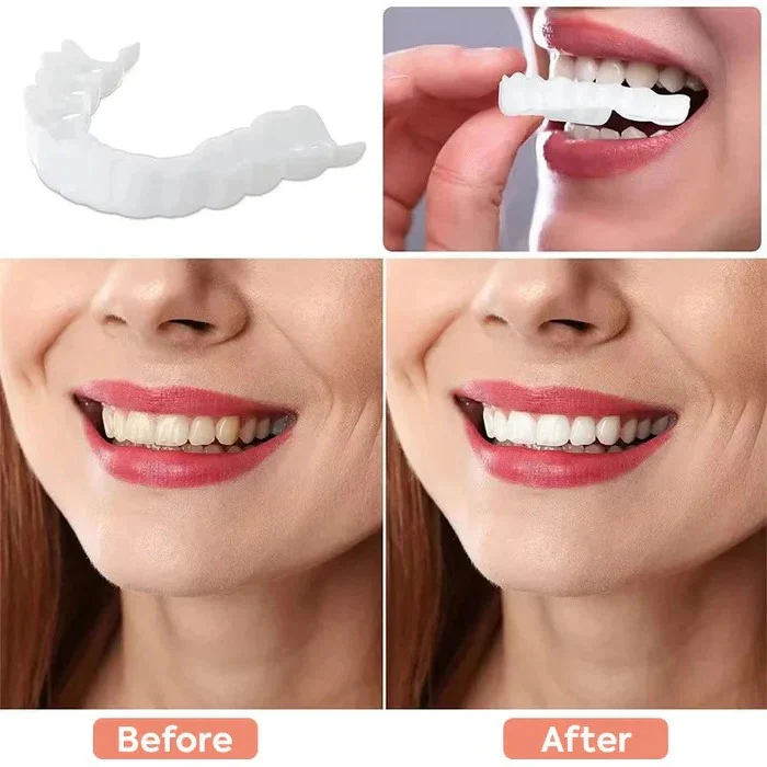 Clip On Cosmetic Veneers and Temporary Tooth Covers - Image 7