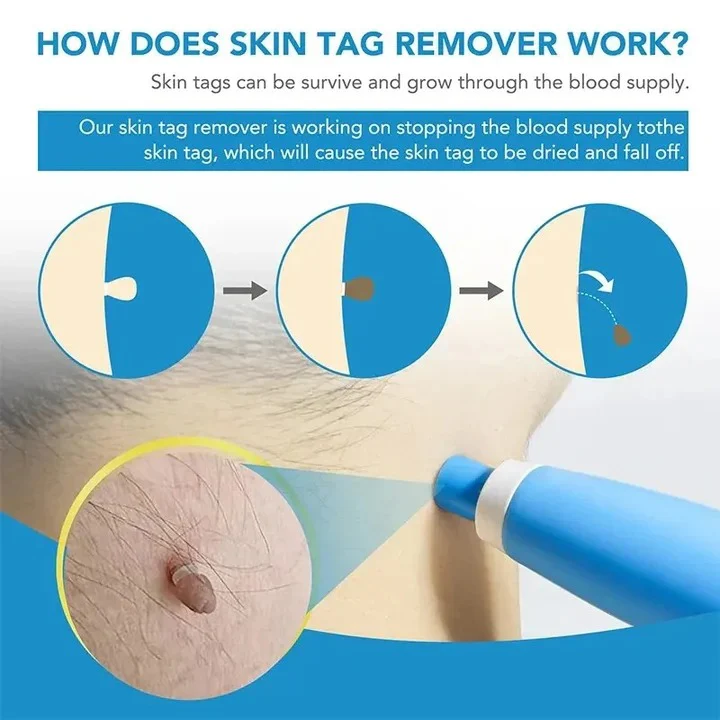 Skin Tag Removal Kit with Silicone Bands & Pen Band Tool - Image 6