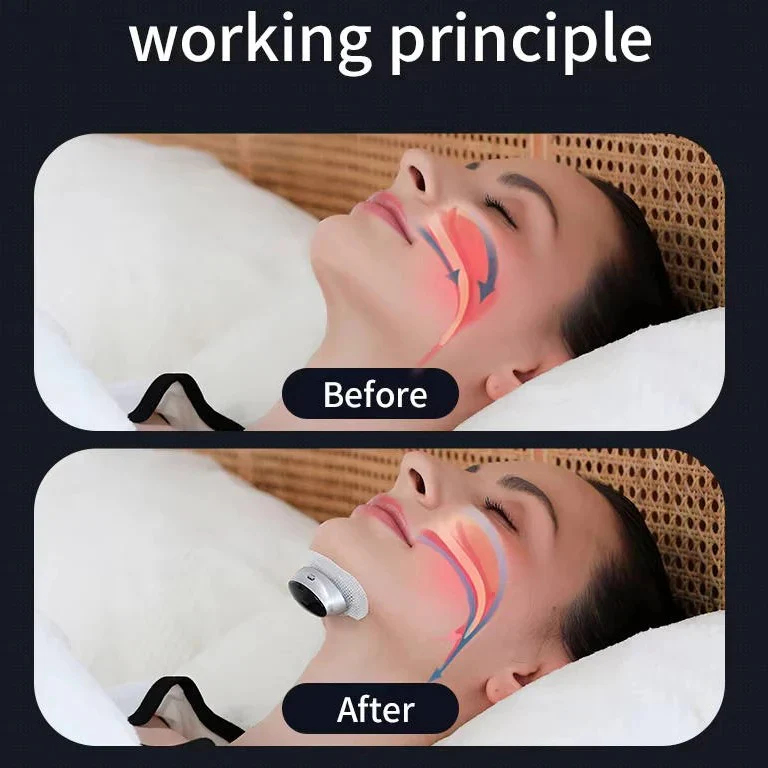 Snoring Support Device with Automatic Stimulation Adjustment - Image 4