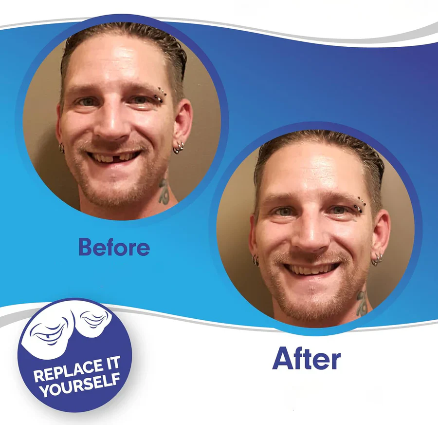 Full Dental Veneer Kit – Upper & Lower Cosmetic Covers - Image 2