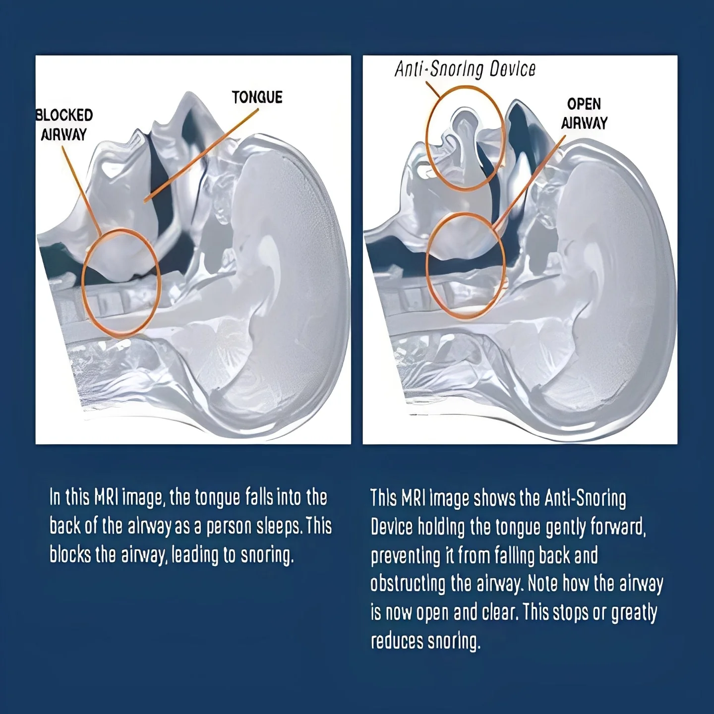 Tongue Positioning Device for Sleep Airflow Support - Image 4